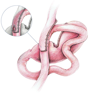 Single Anastomosis Gastric Bypass